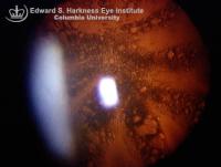 Retroillumination view of a traumatic cataract secondary to fist injury.